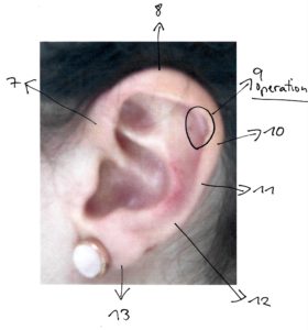 Die starke Einkerbung der linken Ohrleiste zeigt den traumatischen Streß der Operation, die die Klientin mit 9 Jahren über sich ergehen lassen mußte.